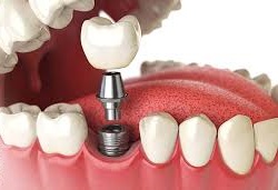 خدمات ویژه دندانپزشکی برای بازنشستگان شیراز با همکاری کلینیک کارا